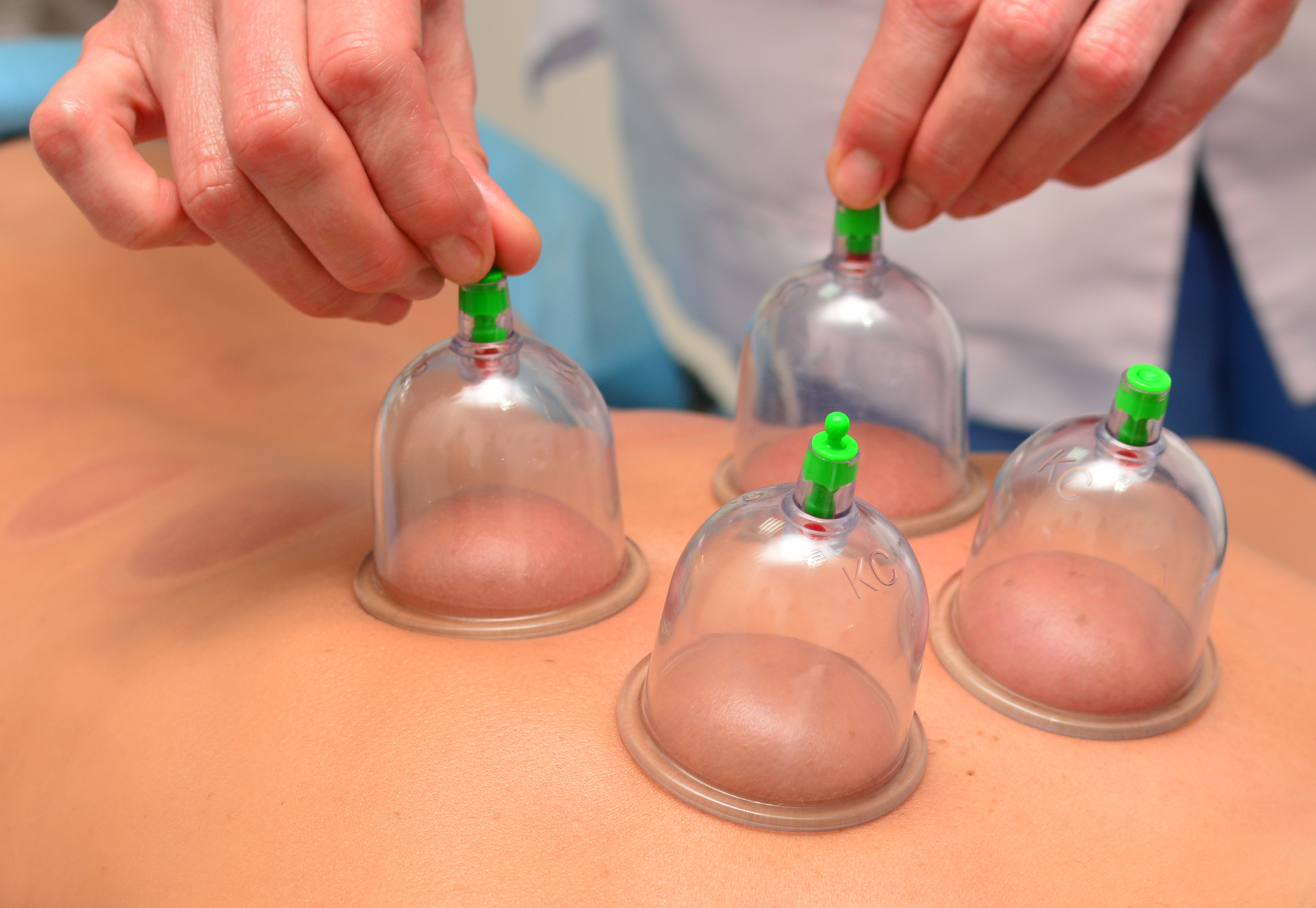 Cupping therapy, woman removes cups from the patient's back