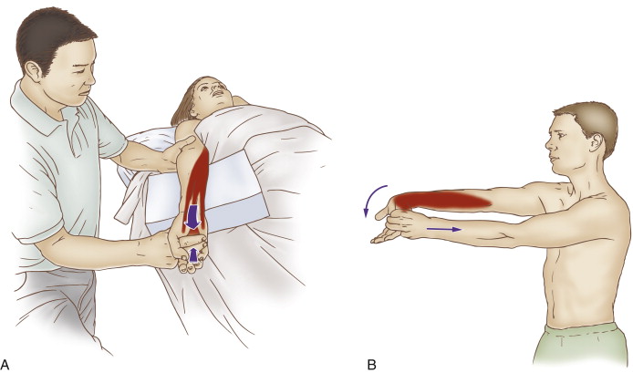 Golfers-Elbow Golfers-Elbow
