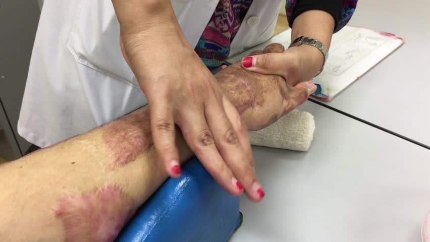 Post Burn Contracture Post Burn Contracture