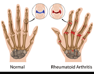 Rheumatoid arthritis