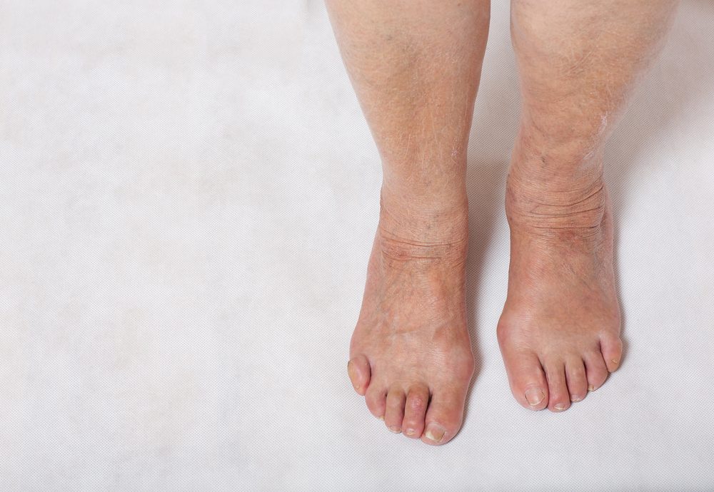 Swelling feet Swelling feet