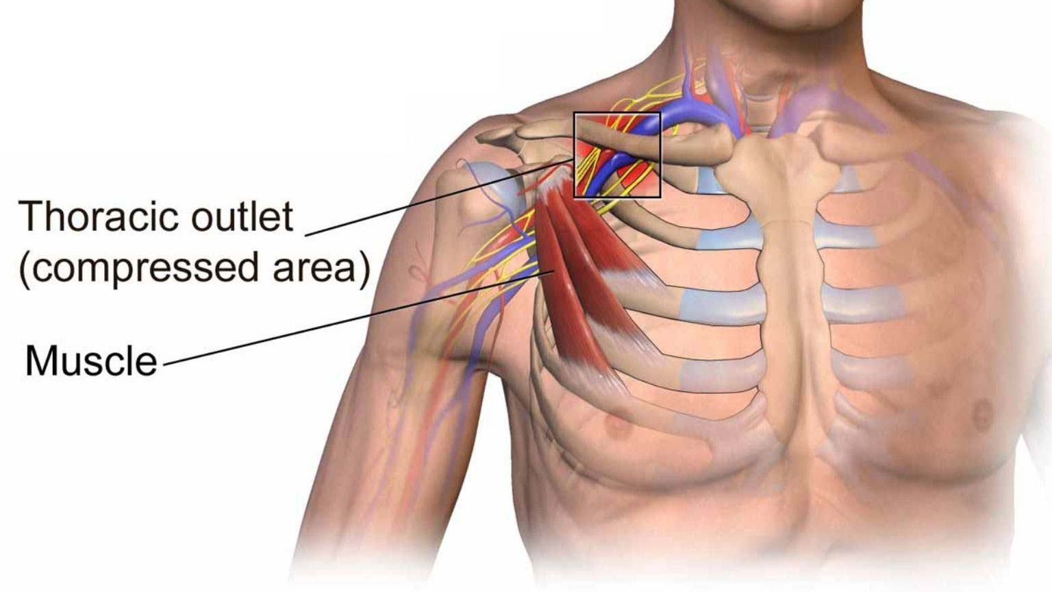 Thoracic-Outlet-Syndrome-TOS Thoracic-Outlet-Syndrome-TOS