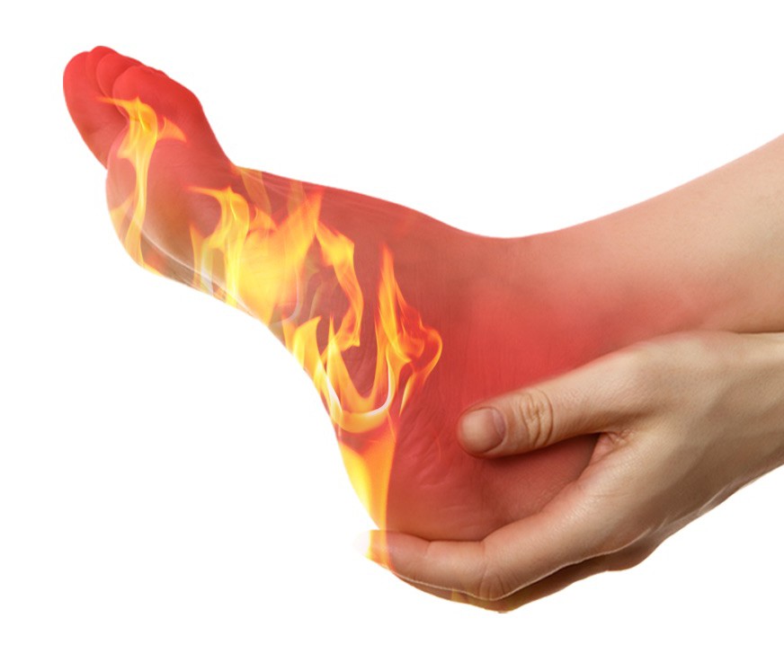 burning_feet