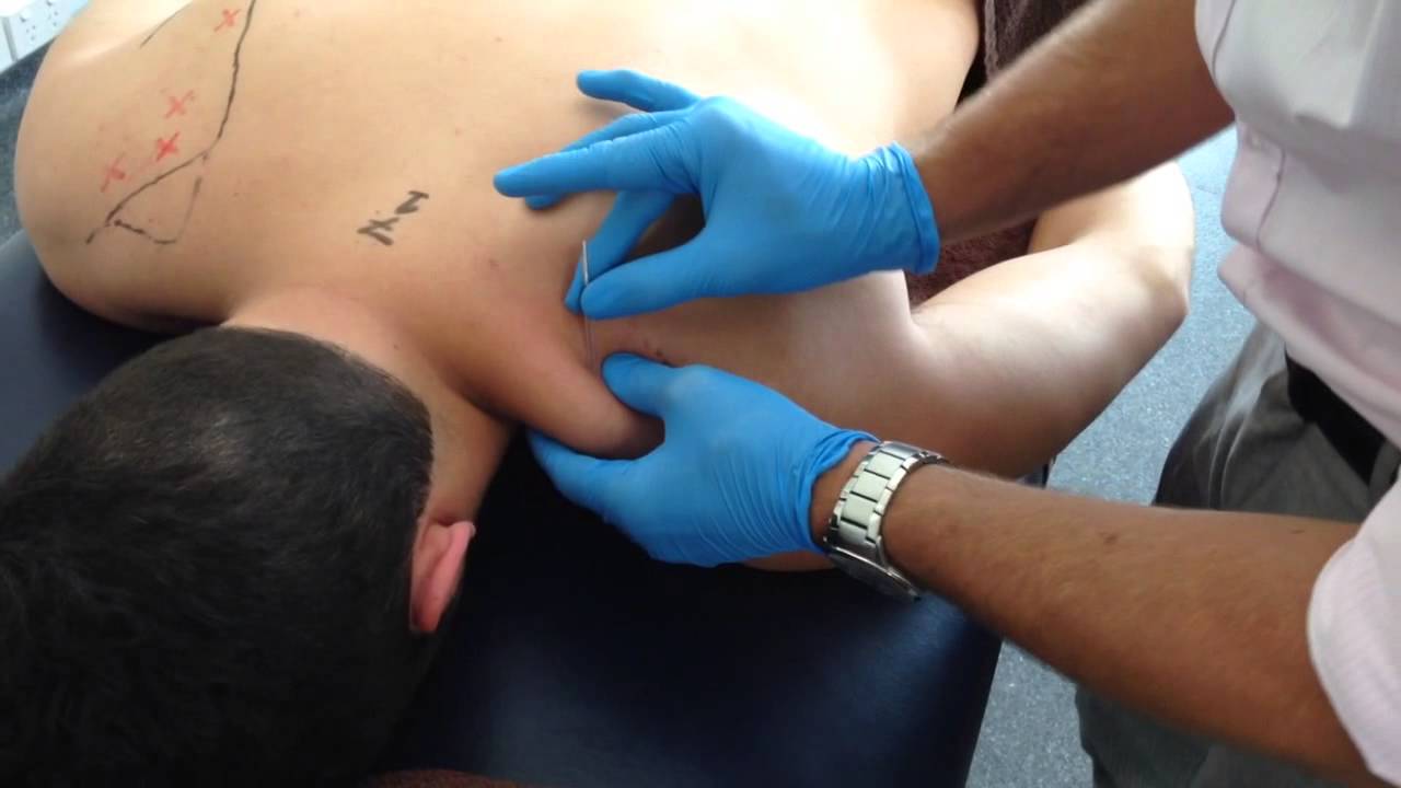 dry needing-ranchi physiotherapy dry needing-ranchi physiotherapy