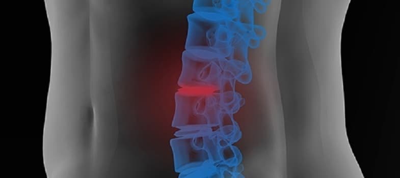 spondylosis (1) spondylosis (1)